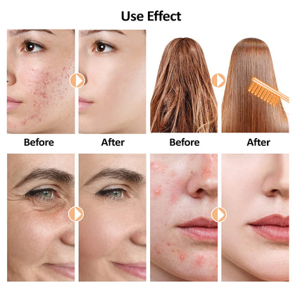 High Frequency Facial Machine for Skin Care
